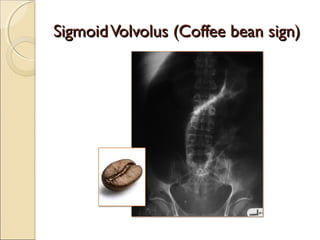 Imaging of acute abdomen | PPT