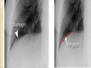 Imaging of acute abdomen | PPT
