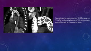imaging of aorta(branches of thorax) (1).pptx