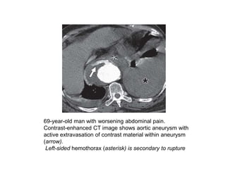 Imaging of aortic pathologies | PPTX