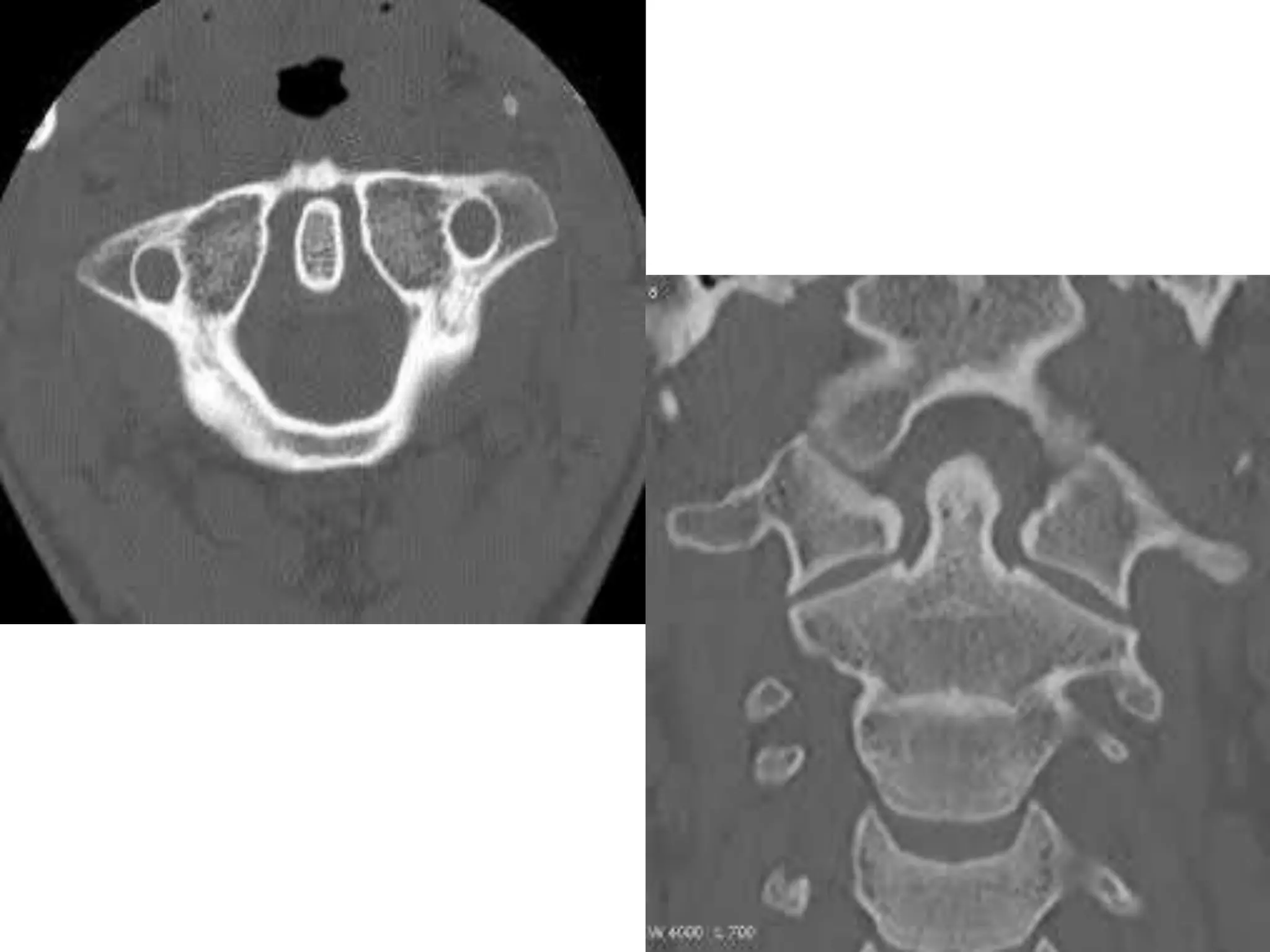 Imaging of atlanto occipital and atlantoaxial traumatic injuries | PPTX