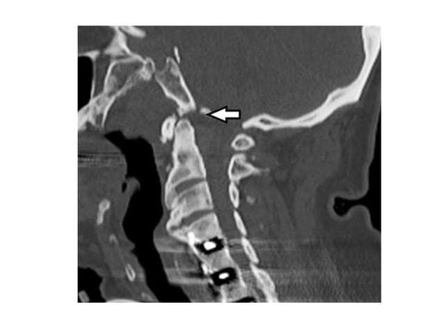 Imaging of atlanto occipital and atlantoaxial traumatic injuries | PPTX