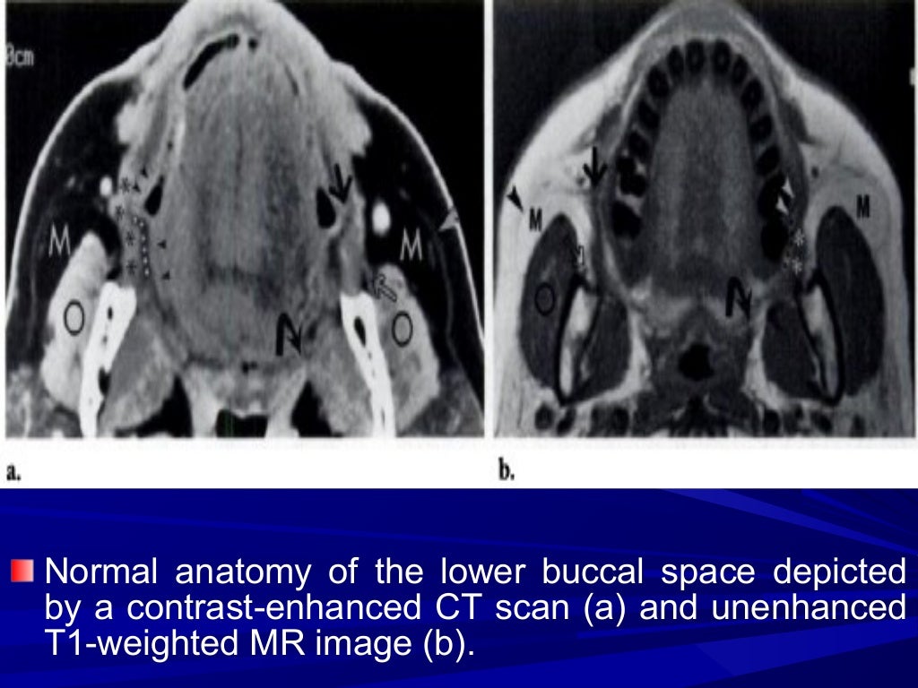 Imaging of buccal space