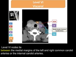 Level VII nodes lie
caudal to the top of the manubrium in the superior mediastinum,
between the medial margins of the left...