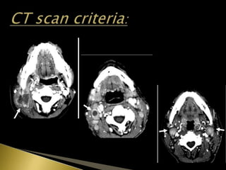  2D-Single-Shot Diffusion-Weighted Echo Planer
Imaging (ss DWEPI ) has been applied to head and
neck imaging.
 DWEPI pro...