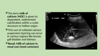 The term milk of
calcium (MOC) is given to
dependent, sedimented
calcification within a cystic
structure or hollow organ.
This sort of colloidal calcium
suspension layering can occur
in various regions like breast,
gall bladder and kidneys
Renal: Milk of calcium in
renal cyst (most common)
 