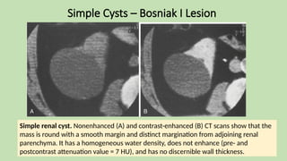 Simple Cysts – Bosniak I Lesion
Simple renal cyst. Nonenhanced (A) and contrast-enhanced (B) CT scans show that the
mass is round with a smooth margin and distinct margination from adjoining renal
parenchyma. It has a homogeneous water density, does not enhance (pre- and
postcontrast attenuation value = 7 HU), and has no discernible wall thickness.
 