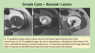 Simple Cysts – Bosniak I Lesion
A, T1-weighted images shows a lesion (arrow) with lower signal intensity than renal
parenchyma. B, On T2-weighted image, the cyst is hyperintense, indicating its fluid content. The
cyst is well defined and has a smooth wall (arrow). C, Postcontrast gradient echo image obtained
after IV injection of Gd-DTPA shows that the lesion (arrow) does not enhance.
 