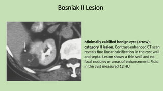 Bosniak II Lesion
Minimally calcified benign cyst (arrow),
category II lesion. Contrast-enhanced CT scan
reveals fine linear calcification in the cyst wall
and septa. Lesion shows a thin wall and no
focal nodules or areas of enhancement. Fluid
in the cyst measured 12 HU.
 