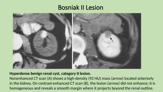 Bosniak II Lesion
Hyperdense benign renal cyst, category II lesion.
Nonenhanced CT scan (A) shows a high-density (92 HU) mass (arrow) located anteriorly
in the kidney. On contrast-enhanced CT scan (B), the lesion (arrow) did not enhance; it is
homogeneous and reveals a smooth margin where it projects beyond the renal outline.
 