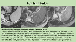 Bosniak II Lesion
Hemorrhagic cyst in upper pole of left kidney, category II lesion.
A, Contrast-enhanced CT scan shows a well- defined mass (arrow) in the upper pole of the left kidney.
The lesion had a precontrast and postcontrast attenuation value of 45 HU. B, Gradient echo MRI shows
fluid-iron level in the cyst, with high-intensity methemoglobin sediment located posteriorly (arrow) and
lower intensity cyst fluid located anteriorly. C, T2-weighted spin echo image reveals that anteriorly
located cyst fluid is hyperintense, whereas dependent sediment (arrow) has a lower signal intensity.
 