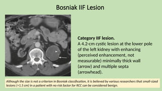 Bosniak IIF Lesion
Category IIF lesion.
A 4.2-cm cystic lesion at the lower pole
of the left kidney with enhancing
(perceived enhancement, not
measurable) minimally thick wall
(arrow) and multiple septa
(arrowhead).
Although the size is not a criterion in Bosniak classification, it is believed by various researchers that small-sized
lesions (<1.5 cm) in a patient with no risk factor for RCC can be considered benign.
 