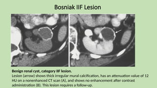 Bosniak IIF Lesion
Benign renal cyst, category IIF lesion.
Lesion (arrow) shows thick irregular mural calcification, has an attenuation value of 12
HU on a nonenhanced CT scan (A), and shows no enhancement after contrast
administration (B). This lesion requires a follow-up.
 