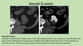 Bosniak III Lesion
Bosniak III lesion.
(a) Axial nonenhanced CT image shows a low-attenuating (18-HU) mass arising from the left kidney. (b)
Axial contrast-enhanced CT image shows multiple measurably enhancing (45 to 75 HU) septations in
the mass (arrow). The lesion was resected and was found to be cystic renal cell carcinoma.
 