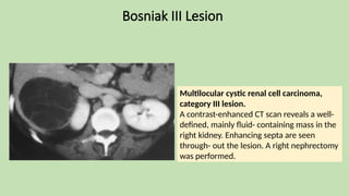 Bosniak III Lesion
Multilocular cystic renal cell carcinoma,
category III lesion.
A contrast-enhanced CT scan reveals a well-
defined, mainly fluid- containing mass in the
right kidney. Enhancing septa are seen
through- out the lesion. A right nephrectomy
was performed.
 