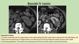 Bosniak IV Lesion
Bosniak IV lesion.
(a) Axial nonenhanced CT image shows a low-attenuating (22-HU) cystic lesion arising from the left kidney. (b)
Axial contrast-enhanced CT image shows an enhancing (114-HU) peripheral nodule (arrow) with subtle
enhancing septations. The lesion was resected and was found to be cystic renal cell carcinoma.
 