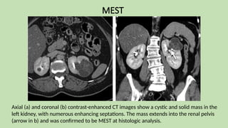 MEST
Axial (a) and coronal (b) contrast-enhanced CT images show a cystic and solid mass in the
left kidney, with numerous enhancing septations. The mass extends into the renal pelvis
(arrow in b) and was confirmed to be MEST at histologic analysis.
 