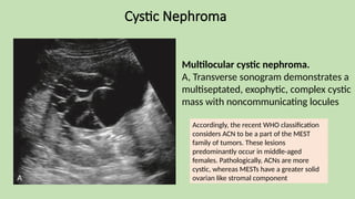 Cystic Nephroma
Multilocular cystic nephroma.
A, Transverse sonogram demonstrates a
multiseptated, exophytic, complex cystic
mass with noncommunicating locules
Accordingly, the recent WHO classification
considers ACN to be a part of the MEST
family of tumors. These lesions
predominantly occur in middle-aged
females. Pathologically, ACNs are more
cystic, whereas MESTs have a greater solid
ovarian like stromal component
 