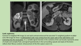 Cystic nephroma.
Coronal T2-weighted MR image (a) and axial contrast-enhanced fat-saturated T1-weighted gradient-recalled-
echo MR image (b) show a multiseptated cystic mass arising from the upper pole of the right kidney and
extending into the renal pelvis. In a, variable signal intensity in the contents of the cyst locules represents areas
of simple and complex fluid, and signal hypointensity in the surrounding capsule and septa of the lesion
reflects their fibrous content. Enhancement of the thin septa is seen in b.
 