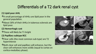 Differentials of a T2 dark renal cyst
(1) Lipid poor AML
A small percentage of AMLs are lipid poor in the
general population.
About 30% of their AMLs in tuberous sclerosis are
lipid poor.
(2) Hemorrhagic cyst
These will likely be T1 bright
(3) Papillary subtype RCC
Clear cells (the most common sub-type) are T2
hyperintense
Both clear cell and papillary will enhance, but the
clear cell enhances more avidly (equal to cortex on
cortico-medullary phase).
 