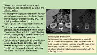 Fifty percent of cases of pyelocalyceal
diverticulum are complicated by calculi and
milk of calcium.
A simple pyelocalyceal diverticulum without
stones has an appearance similar to that of
a simple cyst at ultrasonography (US), MR
imaging, and nonenhanced or
nephrographic phase contrast-enhanced CT.
In the excretory phase of imaging, the
structure fills with contrast material because
of communication with the renal collecting
system, and layering of contrast material is
seen within the cyst like structure.
Complications of pyelocalyceal diverticulum
include hemorrhage, infection, and cyst
rupture. Malignancy in a pyelocalyceal
diverticulum is exceedingly rare, with only
four cases reported in the literature
Pyelocalyceal diverticulum.
(a) Axial contrast-enhanced nephrographic phase CT
image shows calcifications in a cystic renal structure. (b)
Axial contrast-enhanced excretory phase CT image shows
layering of excreted contrast material in the cystic
structure, a finding that proves communication with the
collecting system.
 