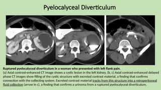Pyelocalyceal Diverticulum
Ruptured pyelocalyceal diverticulum in a woman who presented with left flank pain.
(a) Axial contrast-enhanced CT image shows a cystic lesion in the left kidney. (b, c) Axial contrast-enhanced delayed
phase CT images show filling of the cystic structure with excreted contrast material, a finding that confirms
connection with the collecting system. Excreted contrast material tracks from this structure into a retroperitoneal
fluid collection (arrow in c), a finding that confirms a urinoma from a ruptured pyelocalyceal diverticulum.
 