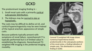 GCKD
The predominant imaging finding is –
1. Small renal cysts with a primarily cortical
subcapsular distribution.
2. The kidneys may be normal in size or
hypoplastic.
The cysts may be difficult to define at US, and
cortical hyperechogenicity may be seen instead
of the typical anechoic appearance of simple
cysts.
Because patients typically present with
symptoms of renal failure, nonenhanced CT is
typically performed but is of limited value in
establishing the diagnosis. Nonenhanced T2-
weighted MR imaging is the preferred imaging
modality.
Coronal T2-weighted MR image shows
numerous hyperintense lesions
predominantly in the subcapsular portions
of the renal cortex, a finding indicative of
simple cysts. This distribution is a classic
finding in GCKD.
 