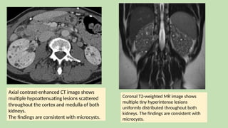 Axial contrast-enhanced CT image shows
multiple hypoattenuating lesions scattered
throughout the cortex and medulla of both
kidneys.
The findings are consistent with microcysts.
Coronal T2-weighted MR image shows
multiple tiny hyperintense lesions
uniformly distributed throughout both
kidneys. The findings are consistent with
microcysts.
 