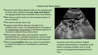 Acquired cystic kidney disease
Acquired cystic kidney disease refers to the development
of renal cysts in patients with end- stage renal disease
who do not already have a heritable cystic renal disease.
Risk factors include male sex and increased duration of
time on dialysis.
The male-to-female ratio is 3:1.
Acquired cystic kidney disease is thought to be
multifactorial in cause. The initiating factor is thought to
be compensatory hypertrophy of functional nephrons in
response to adjacent tissue destruction.
Renal tubular obstruction and expansion caused by
interstitial fibrosis, epithelial hyperplasia, and increased
fluid secretion are thought to lead to cyst development.
There is no correlation with race, cause of renal failure,
or method of dialysis (ie, hemodialysis or peritoneal
dialysis).
Acquired cystic kidney disease. Sagittal
sonogram demonstrates an echogenic small
kidney containing multiple cysts. A small
amount of intraperitoneal dialysate fluid is
seen.
 