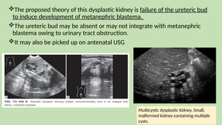 The proposed theory of this dysplastic kidney is failure of the ureteric bud
to induce development of metanephric blastema.
The ureteric bud may be absent or may not integrate with metanephric
blastema owing to urinary tract obstruction.
It may also be picked up on antenatal USG
Multicystic dysplastic kidney. Small,
malformed kidney containing multiple
cysts.
 