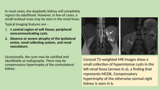 In most cases, the dysplastic kidney will completely
regress by adulthood. However, in few of cases, a
small residual mass may be seen in the renal fossa.
Typical imaging features are –
1. A central region of soft tissue; peripheral
noncommunicating cysts.
2. Absence or severe atrophy of the ipsilateral
ureter, renal collecting system, and renal
vasculature.
Occasionally, the cysts may be calcified and
identifiable at radiography. There may be
compensatory hypertrophy of the contralateral
kidney.
Coronal T2-weighted MR images show a
small collection of hyperintense cysts in the
left renal fossa (arrows in a), a finding that
represents MCDK. Compensatory
hypertrophy of the otherwise normal right
kidney is seen in b.
 