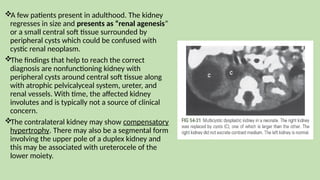 A few patients present in adulthood. The kidney
regresses in size and presents as “renal agenesis”
or a small central soft tissue surrounded by
peripheral cysts which could be confused with
cystic renal neoplasm.
The findings that help to reach the correct
diagnosis are nonfunctioning kidney with
peripheral cysts around central soft tissue along
with atrophic pelvicalyceal system, ureter, and
renal vessels. With time, the affected kidney
involutes and is typically not a source of clinical
concern.
The contralateral kidney may show compensatory
hypertrophy. There may also be a segmental form
involving the upper pole of a duplex kidney and
this may be associated with ureterocele of the
lower moiety.
 
