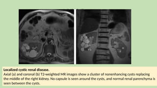 Localized Cystic Renal Disease
Localized cystic renal disease.
Axial (a) and coronal (b) T2-weighted MR images show a cluster of nonenhancing cysts replacing
the middle of the right kidney. No capsule is seen around the cysts, and normal renal parenchyma is
seen between the cysts.
 