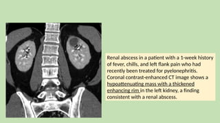 Renal abscess in a patient with a 1-week history
of fever, chills, and left flank pain who had
recently been treated for pyelonephritis.
Coronal contrast-enhanced CT image shows a
hypoattenuating mass with a thickened
enhancing rim in the left kidney, a finding
consistent with a renal abscess.
 