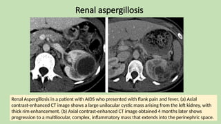 Renal aspergillosis
Renal Aspergillosis in a patient with AIDS who presented with flank pain and fever. (a) Axial
contrast-enhanced CT image shows a large unilocular cystic mass arising from the left kidney, with
thick rim enhancement. (b) Axial contrast-enhanced CT image obtained 4 months later shows
progression to a multilocular, complex, inflammatory mass that extends into the perinephric space.
 