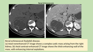 Renal Echinococcosis
Renal echinococcal (hydatid) disease.
(a) Axial nonenhanced CT image shows a complex cystic mass arising from the right
kidney. (b) Axial contrast-enhanced CT image shows the thick enhancing wall of the
mass, with enhancing internal septations.
 