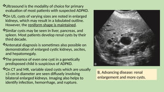 Ultrasound is the modality of choice for primary
evaluation of most patients with suspected ADPKD.
On US, cysts of varying sizes are noted in enlarged
kidneys, which may result in a lobulated outline.
However, the reniform shape is maintained.
Similar cysts may be seen in liver, pancreas, and
spleen. Most patients develop renal cysts by their
third decade.
Antenatal diagnosis is sometimes also possible on
demonstration of enlarged cystic kidneys, ascites,
and hepatomegaly.
The presence of even one cyst in a genetically
predisposed child is suspicious of ADPKD.
On CT and MR, variable sized cysts which are usually
≥3 cm in diameter are seen diffusely involving
bilateral enlarged kidneys. Imaging also helps to
identify infection, hemorrhage, and rupture.
B, Advancing disease: renal
enlargement and more cysts.
 
