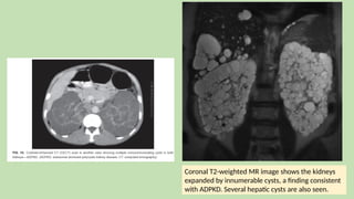 Coronal T2-weighted MR image shows the kidneys
expanded by innumerable cysts, a finding consistent
with ADPKD. Several hepatic cysts are also seen.
 