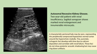 Autosomal Recessive Kidney Disease.
Two-year-old patient with renal
insufficiency. Sagittal sonogram shows
marked renal enlargement and
innumerable microcysts.
A characteristic perirenal halo may be seen, representing
the peripherally compressed hypoechoic normal cortex
around the hyperechoic medulla. Tiny, punctate,
echogenic foci develop with time due to calcium
deposition and correlate with renal failure. These foci
do not show posterior acoustic shadowing but may cause
ring-down artifacts.
 