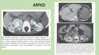 ARPKD
 