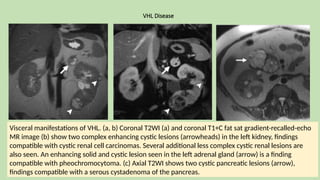 VHL Disease
Visceral manifestations of VHL. (a, b) Coronal T2WI (a) and coronal T1+C fat sat gradient-recalled-echo
MR image (b) show two complex enhancing cystic lesions (arrowheads) in the left kidney, findings
compatible with cystic renal cell carcinomas. Several additional less complex cystic renal lesions are
also seen. An enhancing solid and cystic lesion seen in the left adrenal gland (arrow) is a finding
compatible with pheochromocytoma. (c) Axial T2WI shows two cystic pancreatic lesions (arrow),
findings compatible with a serous cystadenoma of the pancreas.
 