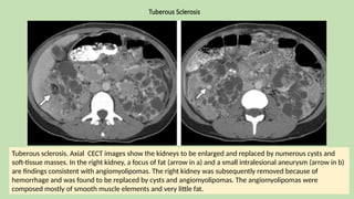 Tuberous Sclerosis
Tuberous sclerosis. Axial CECT images show the kidneys to be enlarged and replaced by numerous cysts and
soft-tissue masses. In the right kidney, a focus of fat (arrow in a) and a small intralesional aneurysm (arrow in b)
are findings consistent with angiomyolipomas. The right kidney was subsequently removed because of
hemorrhage and was found to be replaced by cysts and angiomyolipomas. The angiomyolipomas were
composed mostly of smooth muscle elements and very little fat.
 