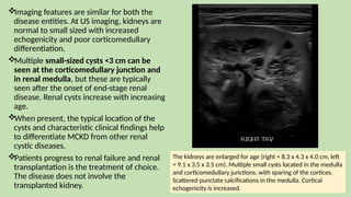 Imaging features are similar for both the
disease entities. At US imaging, kidneys are
normal to small sized with increased
echogenicity and poor corticomedullary
differentiation.
Multiple small-sized cysts <3 cm can be
seen at the corticomedullary junction and
in renal medulla, but these are typically
seen after the onset of end-stage renal
disease. Renal cysts increase with increasing
age.
When present, the typical location of the
cysts and characteristic clinical findings help
to differentiate MCKD from other renal
cystic diseases.
Patients progress to renal failure and renal
transplantation is the treatment of choice.
The disease does not involve the
transplanted kidney.
The kidneys are enlarged for age (right = 8.3 x 4.3 x 4.0 cm, left
= 9.1 x 3.5 x 3.5 cm). Multiple small cysts located in the medulla
and corticomedullary junctions, with sparing of the cortices.
Scattered punctate calcifications in the medulla. Cortical
echogenicity is increased.
 