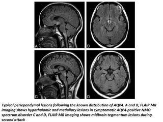 Typical periependymal lesions following the known distribution of AQP4. A and B, FLAIR MR
imaging shows hypothalamic and medullary lesions in symptomatic AQP4-positive NMO
spectrum disorder C and D, FLAIR MR imaging shows midbrain tegmentum lesions during
second attack
 