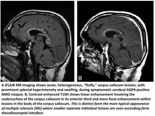 A )FLAIR MR imaging shows acute, heterogeneous, “fluffy,” corpus callosum lesions, with
prominent splenial hyperintensity and swelling, during symptomatic cerebral AQP4-positive
NMO relapse. B, Contrast-enhanced T1WI shows linear enhancement involving the
undersurface of the corpus callosum in its anterior third and more focal enhancement within
lesions in the body of the corpus callosum. This is distinct form the more typical appearance
of multiple sclerosis (MS) where smaller separate individual lesions are seen ascending form
thecallososeptal interface.
 
