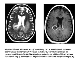 45-year-old male with TMS. MRI of this case of TMS in an adult male patient is
characterized by more classic features, including a periventricular lesion on
conventional T2-weighted MRI with edema and minimal midline shift (A), with an
incomplete ring of enhancement on gadolinium-enhanced T1-weighted images (B).
 