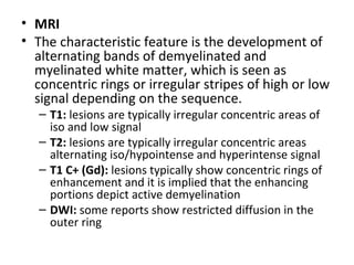 • MRI
• The characteristic feature is the development of
alternating bands of demyelinated and
myelinated white matter, which is seen as
concentric rings or irregular stripes of high or low
signal depending on the sequence.
– T1: lesions are typically irregular concentric areas of
iso and low signal
– T2: lesions are typically irregular concentric areas
alternating iso/hypointense and hyperintense signal
– T1 C+ (Gd): lesions typically show concentric rings of
enhancement and it is implied that the enhancing
portions depict active demyelination
– DWI: some reports show restricted diffusion in the
outer ring
 