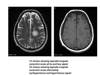 T1: lesions showing typically irregular
concentric areas of iso and low signal
T2: lesions showing typically irregular
concentric areas alternating
iso/hypointense and hyperintense signal
 