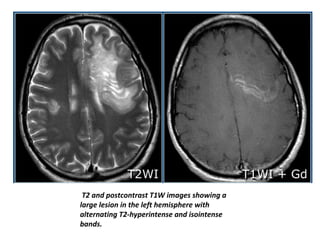 T2 and postcontrast T1W images showing a
large lesion in the left hemisphere with
alternating T2-hyperintense and isointense
bands.
 