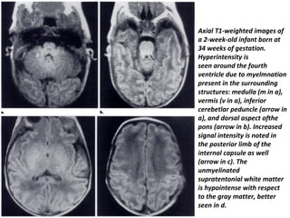 Axial T1-weighted images of
a 2-week-old infant born at
34 weeks of gestation.
Hyperintensity is
seen around the fourth
ventricle due to myelmnation
present in the surrounding
structures: medulla (m in a),
vermis (v in a), inferior
cerebetlar peduncle (arrow in
a), and dorsal aspect ofthe
pons (arrow in b). Increased
signal intensity is noted in
the posterior limb of the
internal capsule as well
(arrow in c). The
unmyelinated
supratentonial white matter
is hypointense with respect
to the gray matter, better
seen in d.
 